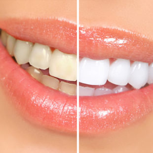 blanqueamiento dental - estética dental en Terrassa