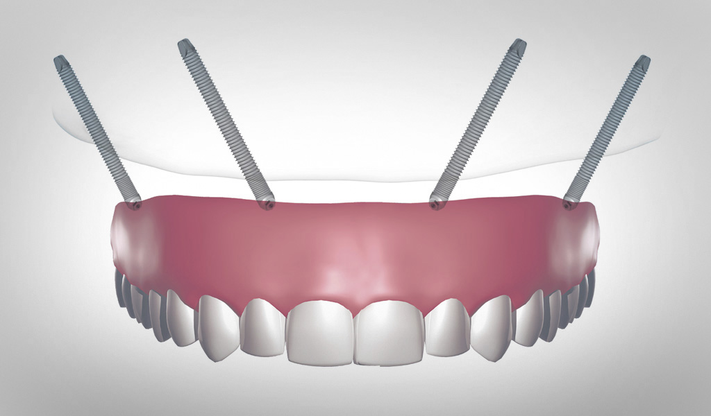 implantes dentales en Terrassa