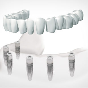 implantes dentales dentadura fija